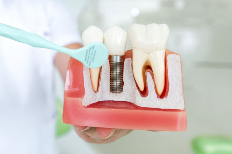 Dental implant